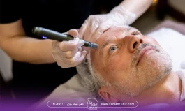 علت تیرگی پوست بعد از میکرونیدلینگ چیست؟